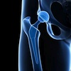 réopérations précoces pour les prothèses de hanche, qualité des résultats